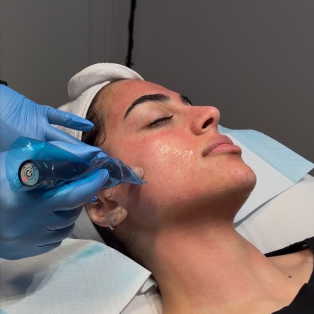 Rose Prick Renewal -Microneedling 3 at Beauty Witch Aesthetics in Kent, WA